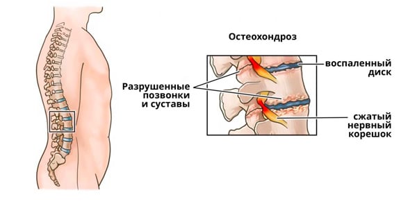 Причины и методы лечения остеохондроза пояснично-крестцового отдела
